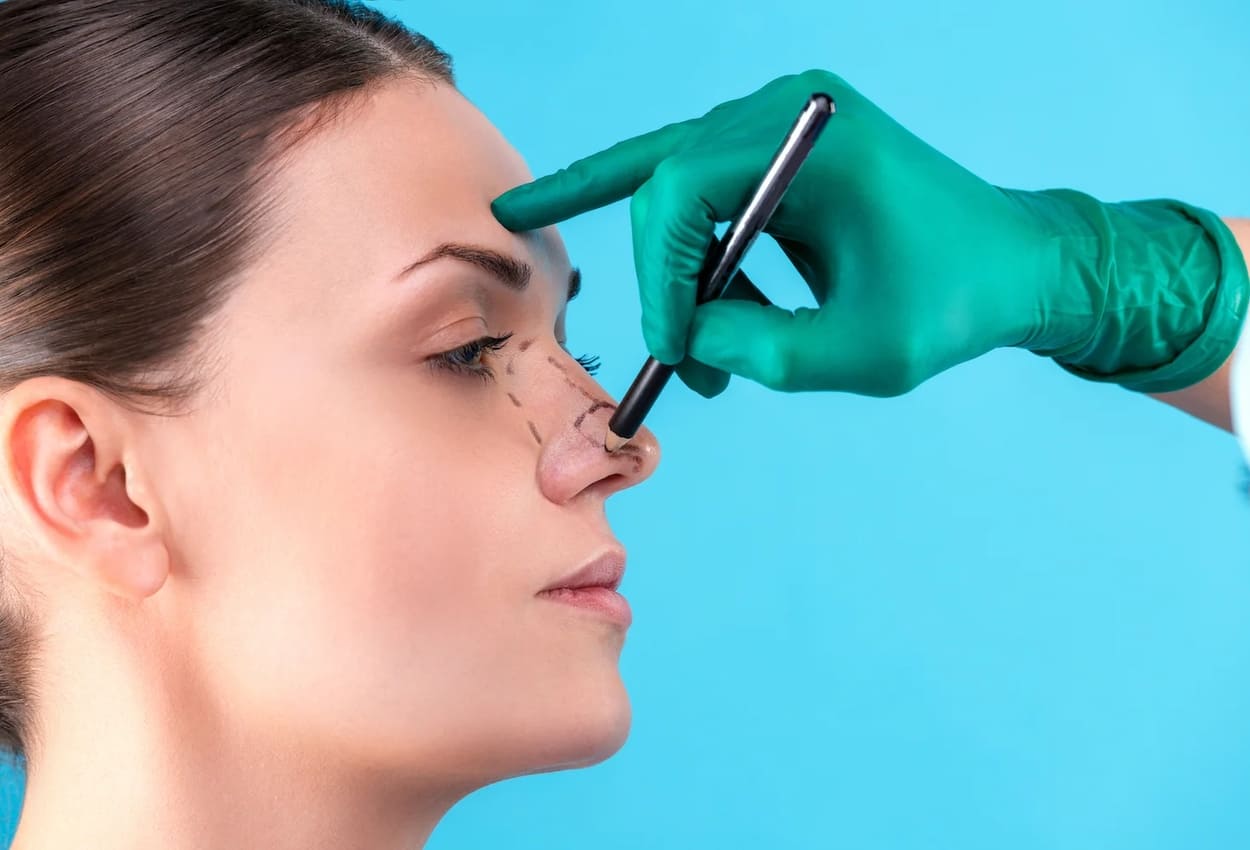Rinoplastia: Tudo o que você precisa saber sobre os cuidados e benefícios