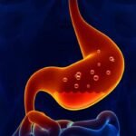 10 Dicas para Aliviar os Sintomas do Refluxo Gastroesofágico