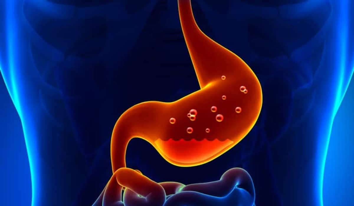 10 Dicas para Aliviar os Sintomas do Refluxo Gastroesofágico