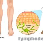 Lipedema: o que é sintomas e tratamento essenciais para o controle