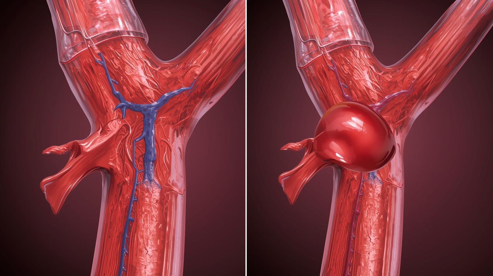 Trombose: Entenda o Que É, Causas e Como Se Proteger